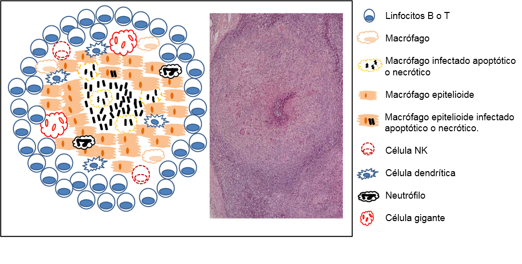 Tuberculosis Figure.2