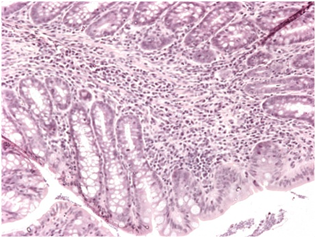 Ulcerative colitis and Trichuris Infection Figure 2 a