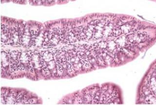 Ulcerative colitis and Trichuris Infection Figure.1.