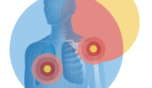 Illustration of torso with shoulder and lung highlighted