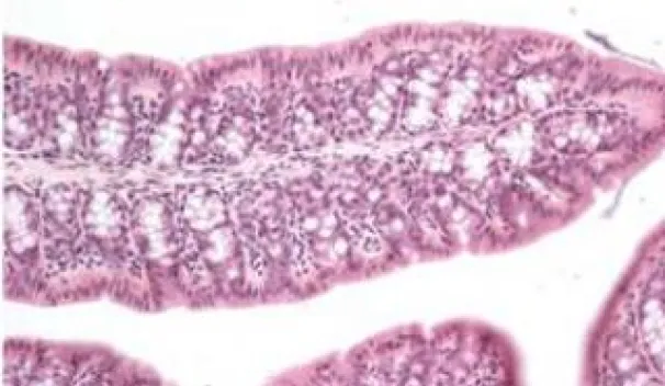 Ulcerative colitis