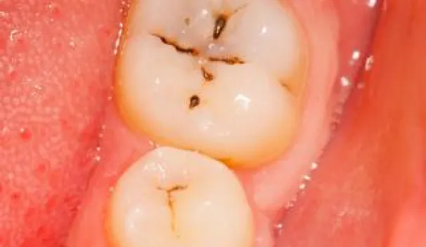 Immunity in the oral cavity