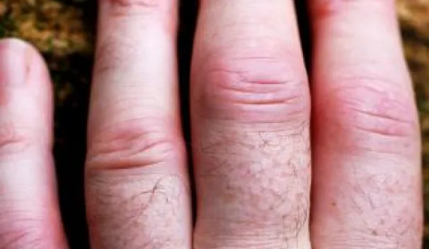 Rheumatoid Arthritis