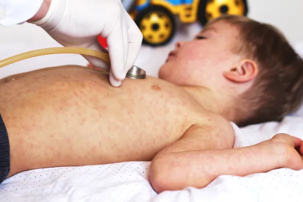 Child with measles 