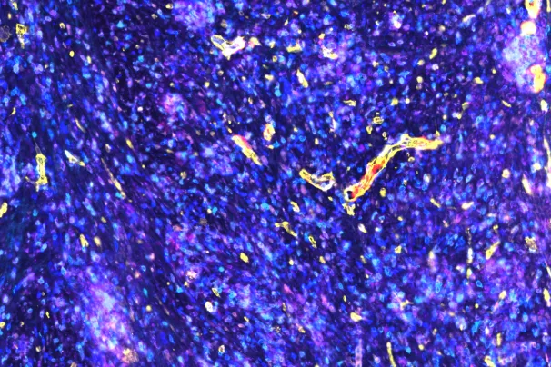 : Fibrosarcoma following regulatory T-cell depletion. Treatment results in development of high endothelial venules (yellow/red) and enhanced T-cell infiltration (aqua, purple and blue).